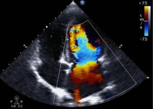 What Does a Cardiovascular Sonographer Do?